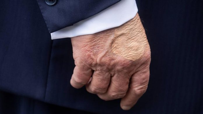 FOTO: Penampakan Tangan Trump Memar Ditutupi Makeup